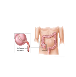 Appendix Treatment by Laparoscopic Surgeon in Mumbai