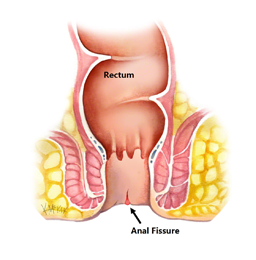 Fissure Treatment by General Surgeon in Mumbai