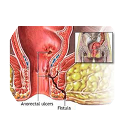 Fistula Treatment by General Surgeon in Mumbai