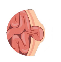 Hernia Treatment by Laparoscopic Surgeon in Mumbai