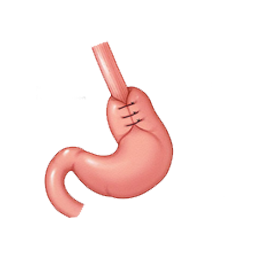 Hiatal Surgery by Laparoscopic Surgeon in Mumbai